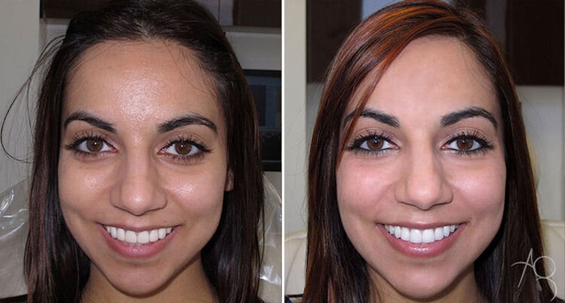 Smile Makeover Before & After Gallery - Patient 167602707 - Image 1