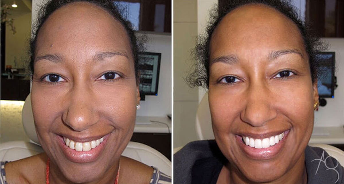 Smile Makeover Before & After Gallery - Patient 167602706 - Image 1