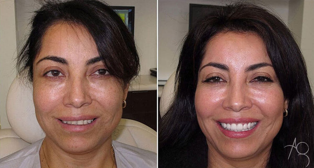 Smile Makeover Before & After Gallery - Patient 167602705 - Image 1