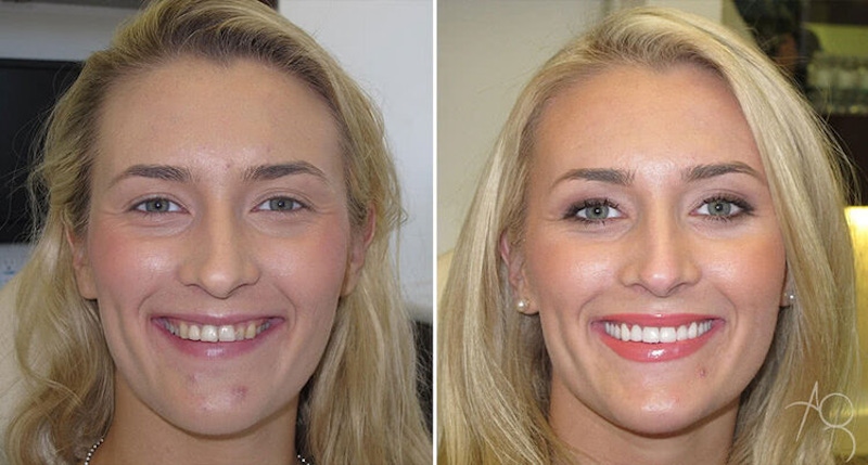 Smile Makeover Before & After Gallery - Patient 167602704 - Image 1