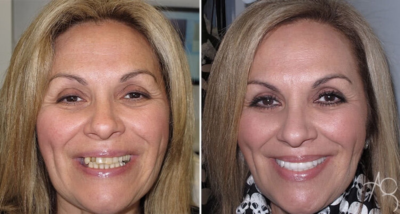 Smile Makeover Before & After Gallery - Patient 167602703 - Image 1