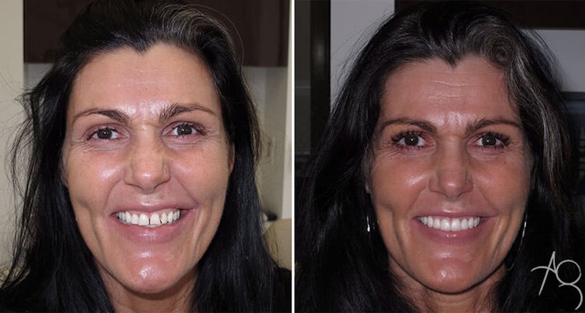 Smile Makeover Before & After Gallery - Patient 167602702 - Image 1