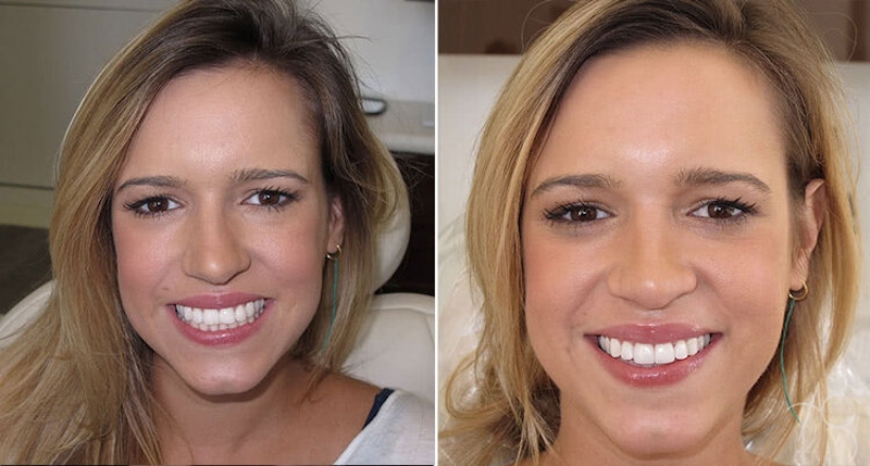 Smile Makeover Before & After Gallery - Patient 167602542 - Image 1