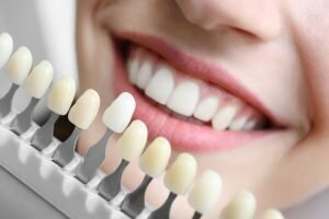 over-the-counter tooth-whitening treatments