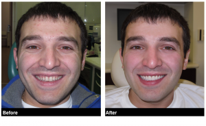 Before and After pictures of a man who got perfect veneers for his teeth