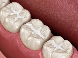 natural tooth color composite fillings