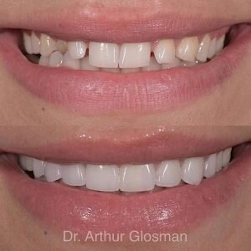 veneers results