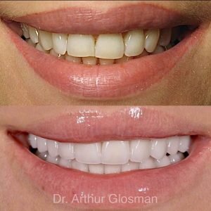Beverly Hills veneers before and after