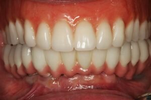 All On 6 dental implants after picture