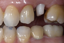 picture of a patient's abutment extending from a Post