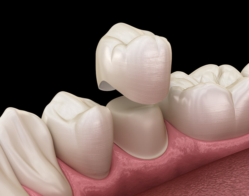 digital rendering of a dental crown