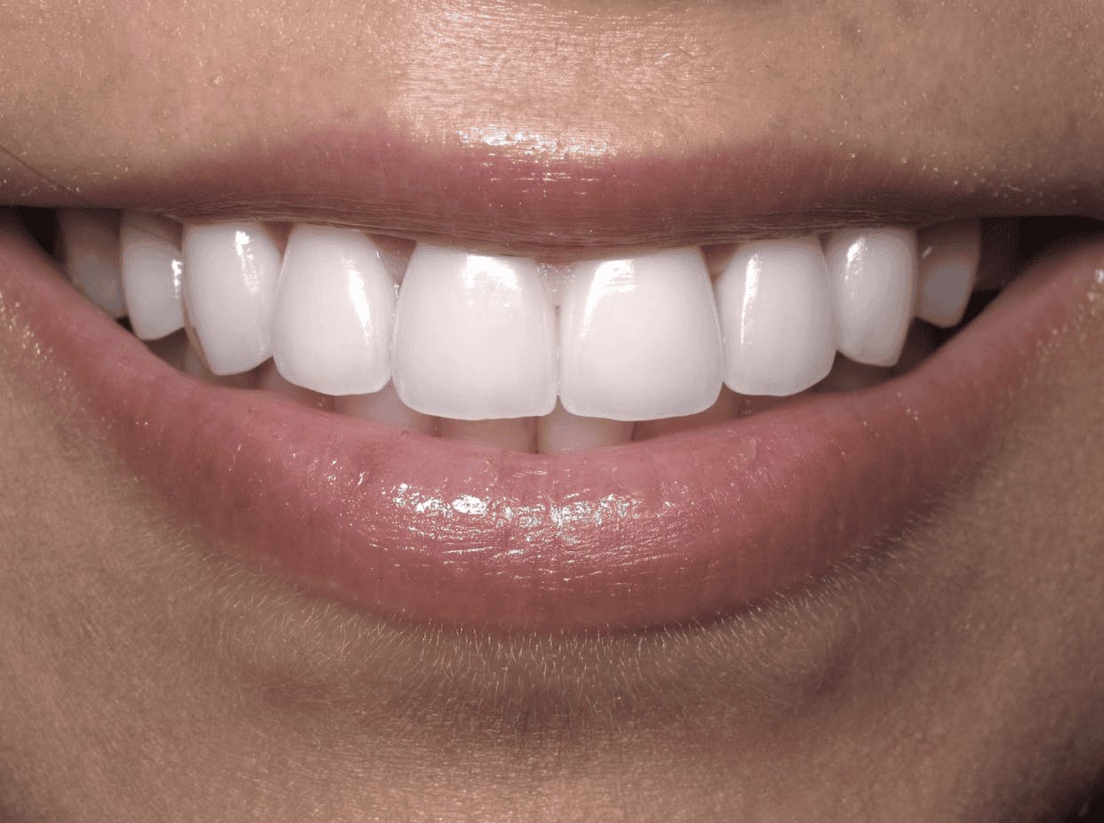 white teeth