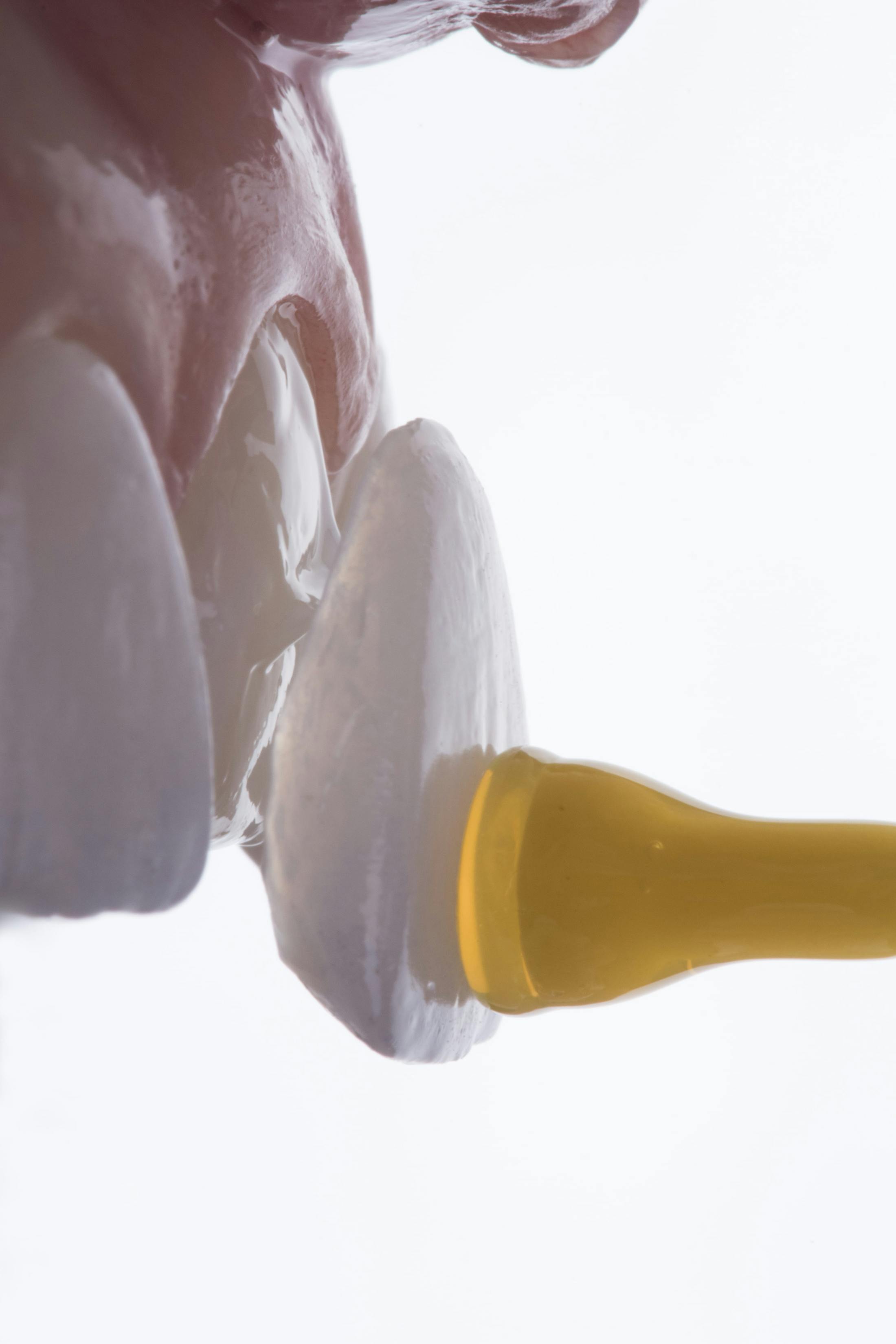 veneer replacement
