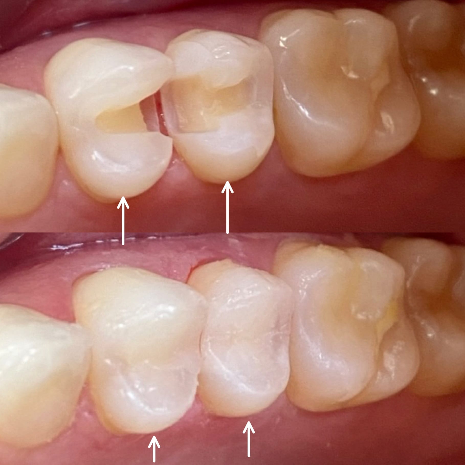 Metal Free Fillings Beverly Hills Cavity Fillings in Beverly Hills