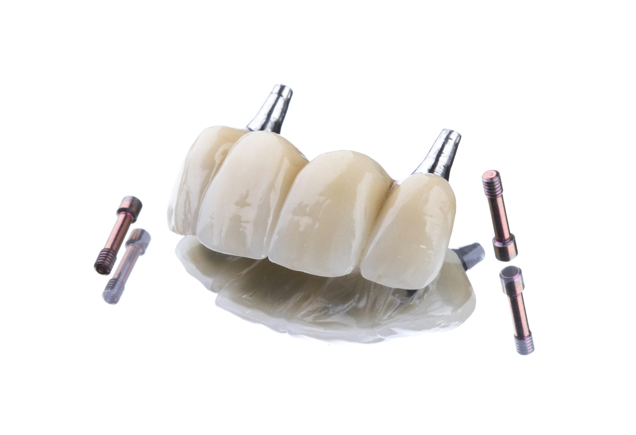 Dental Bridge