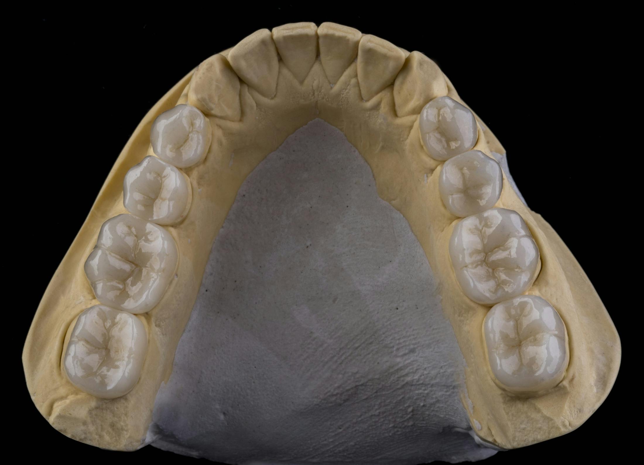 Dental Crown