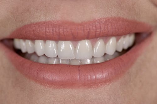 Dental Bridge After