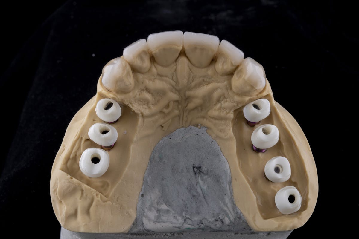 Dental Implants Before