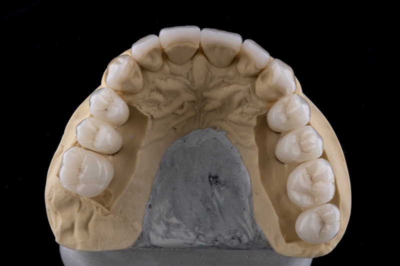 Dental Implants After