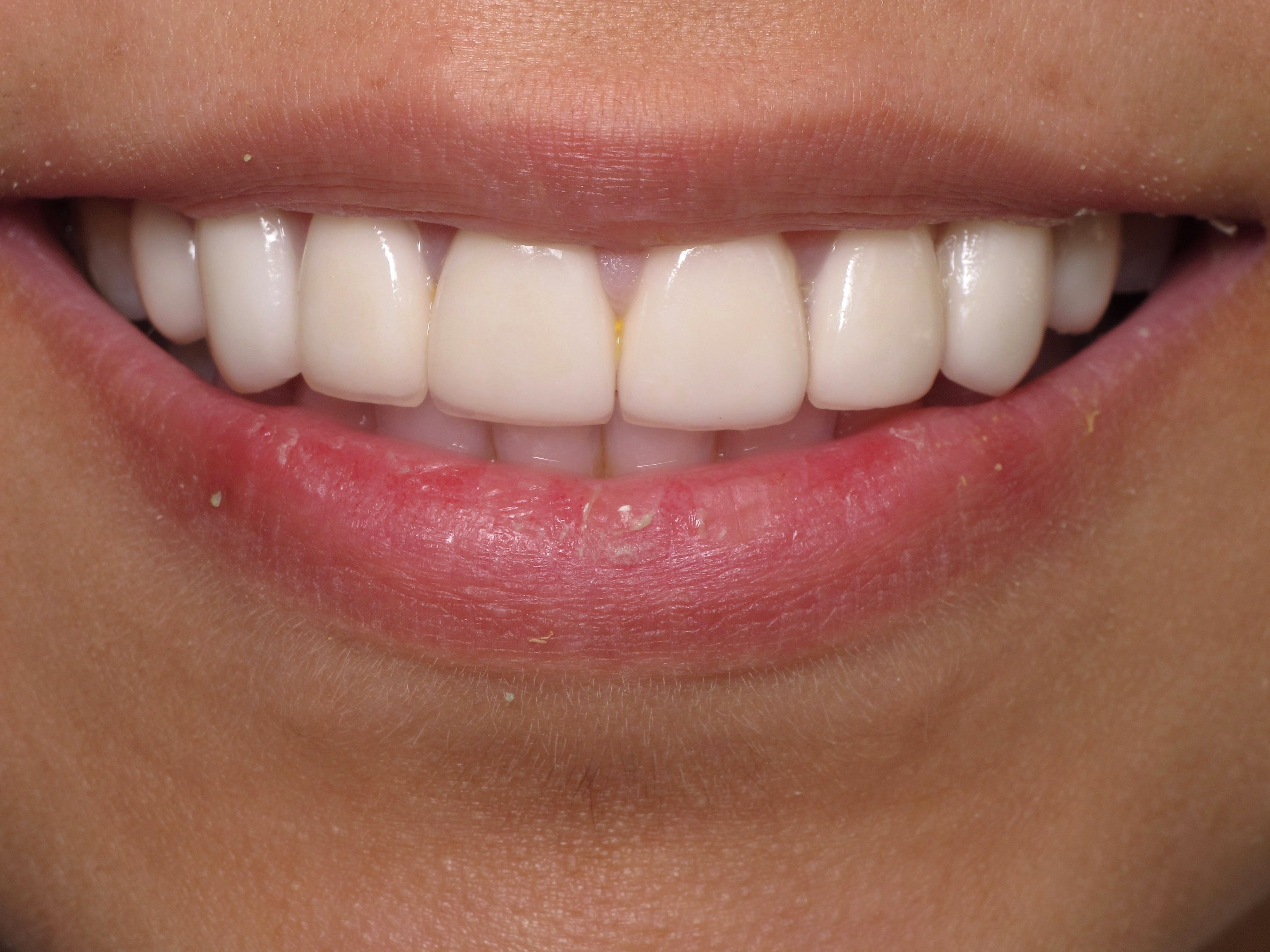 Porcelain Veneers in Beverly Hills
