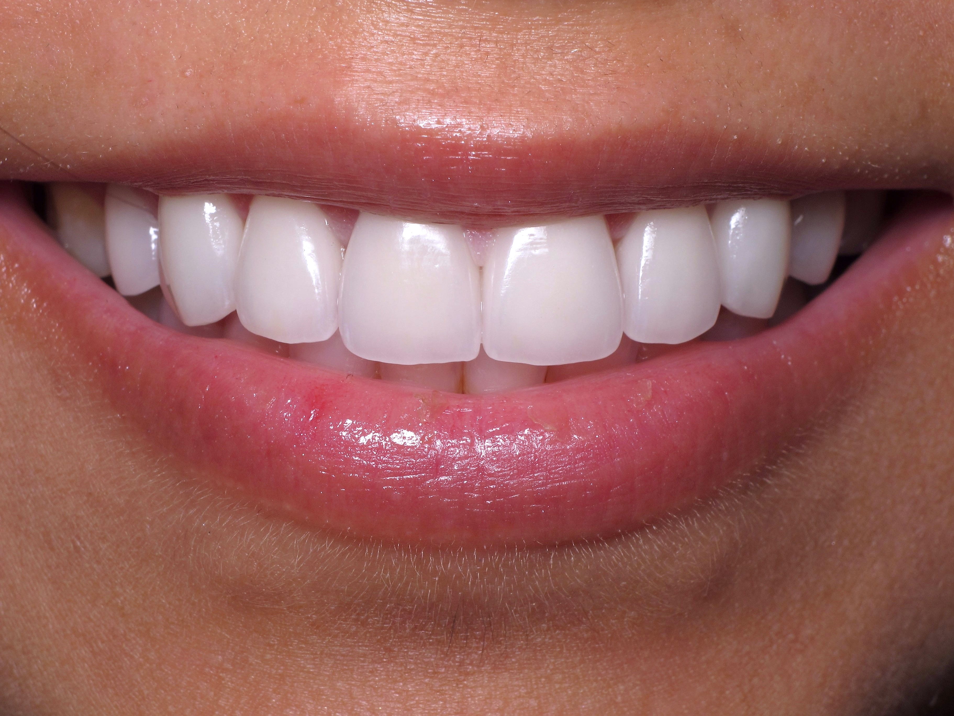 Porcelain Veneers in Beverly Hills