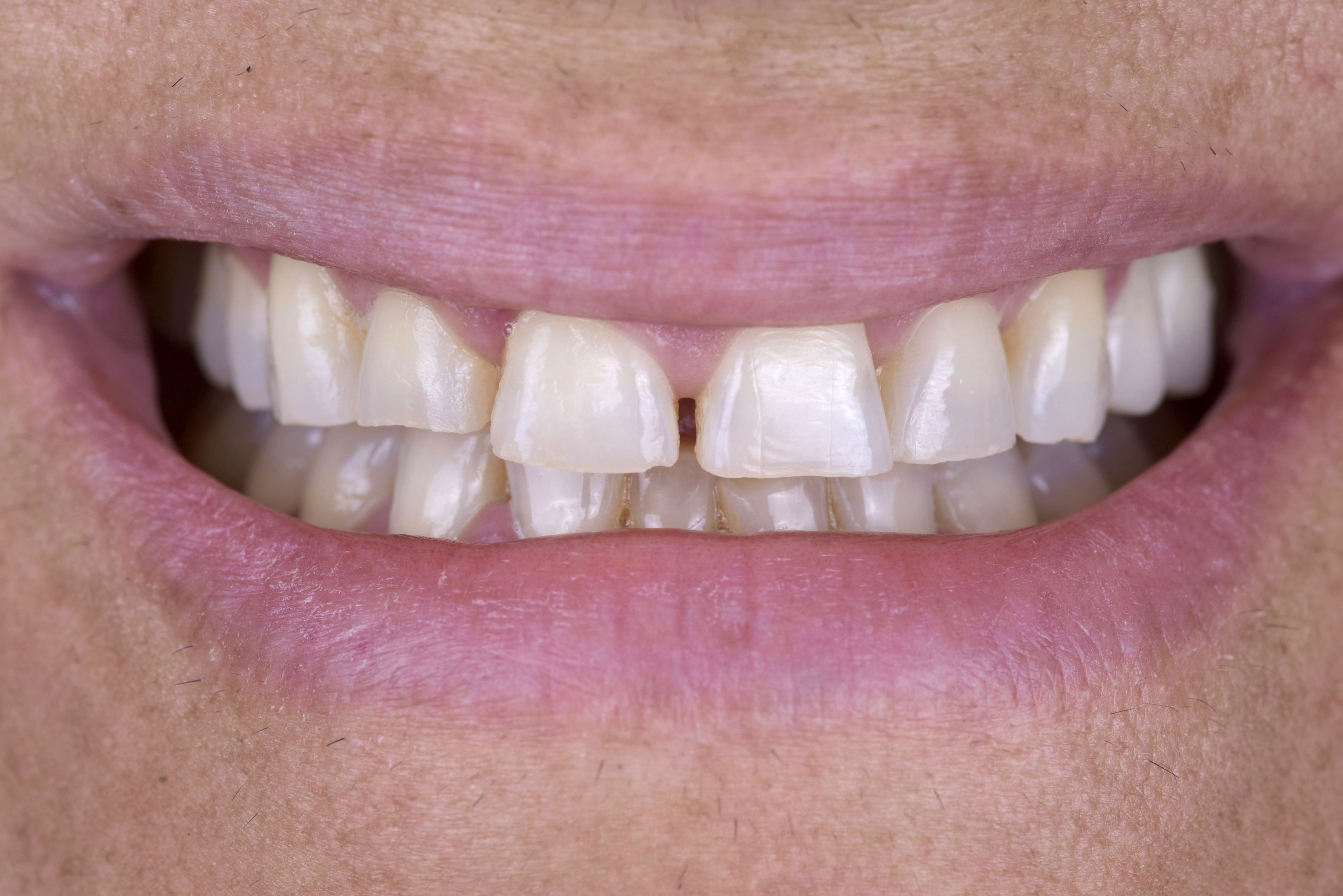 Porcelain Veneers in Beverly Hills