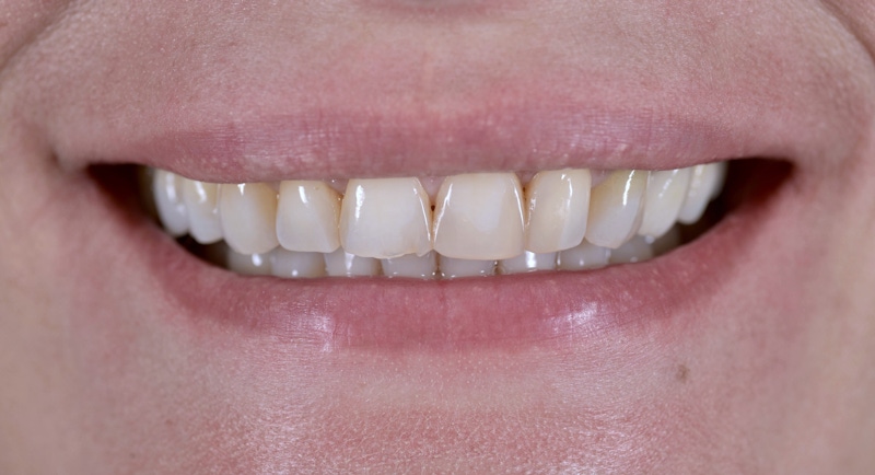 Smile Makeover Before
