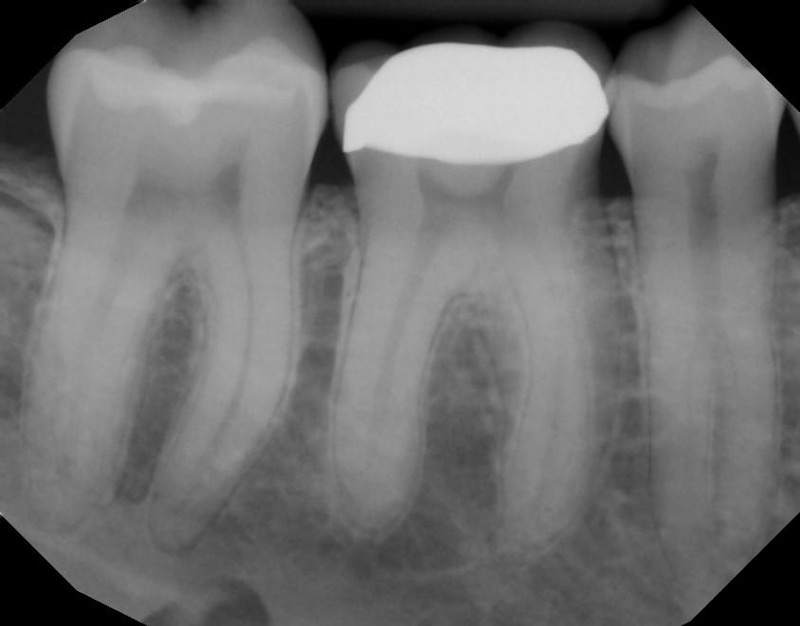 Root Canal Before