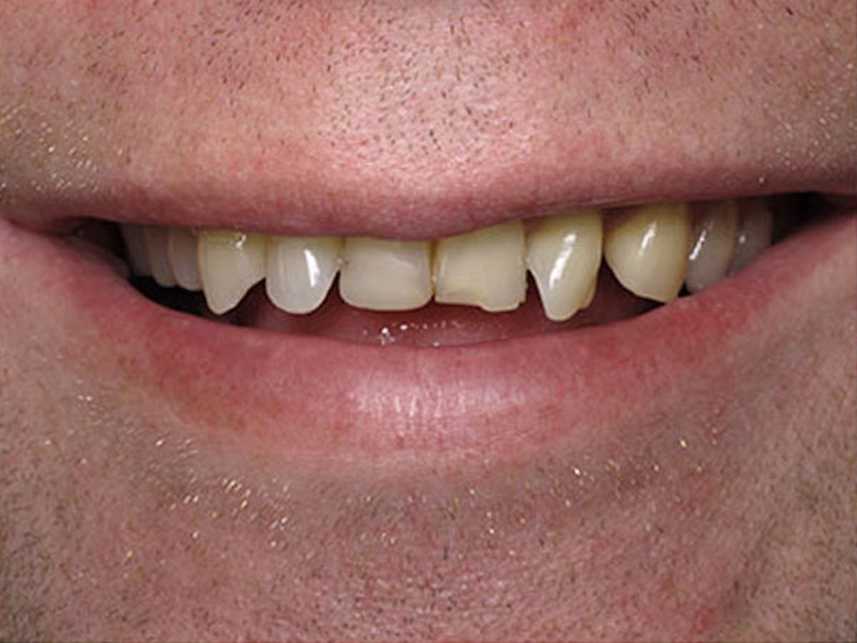 Smile Makeover Closeups Before & After Gallery - Patient 186105653 - Image 1