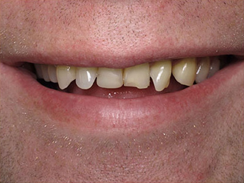 Smile Makeover Closeups Before & After Gallery - Patient 186105653 - Image 1