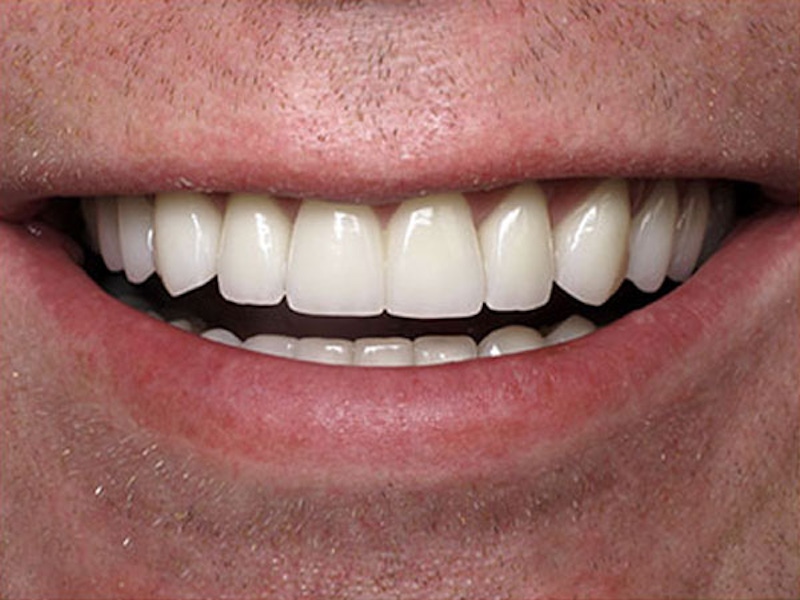 Smile Makeover Closeups Before & After Gallery - Patient 186105653 - Image 2