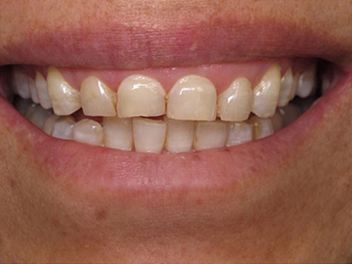 Smile Makeover Closeups Before & After Gallery - Patient 186105654 - Image 1