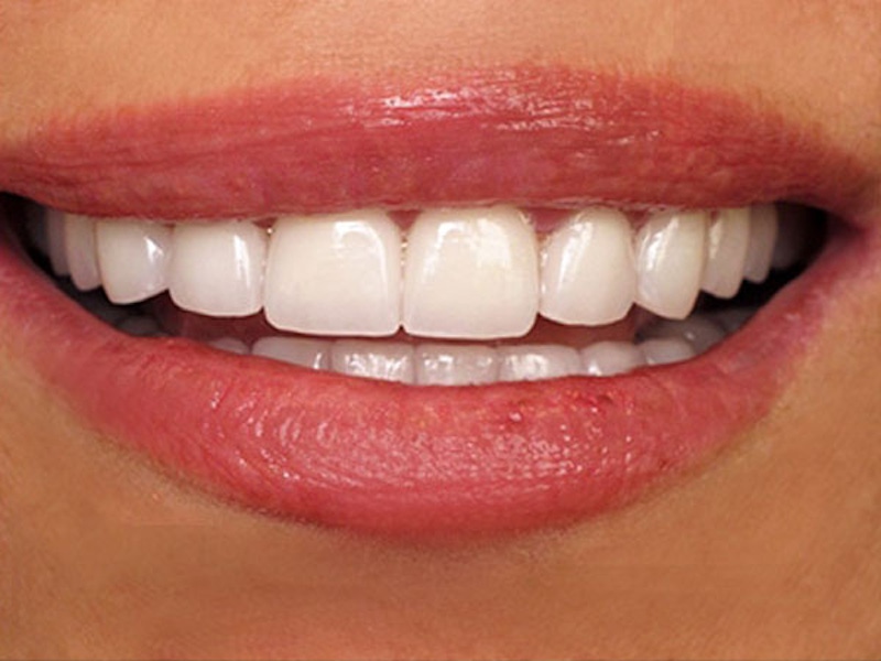 Smile Makeover Closeups Before & After Gallery - Patient 186105654 - Image 2