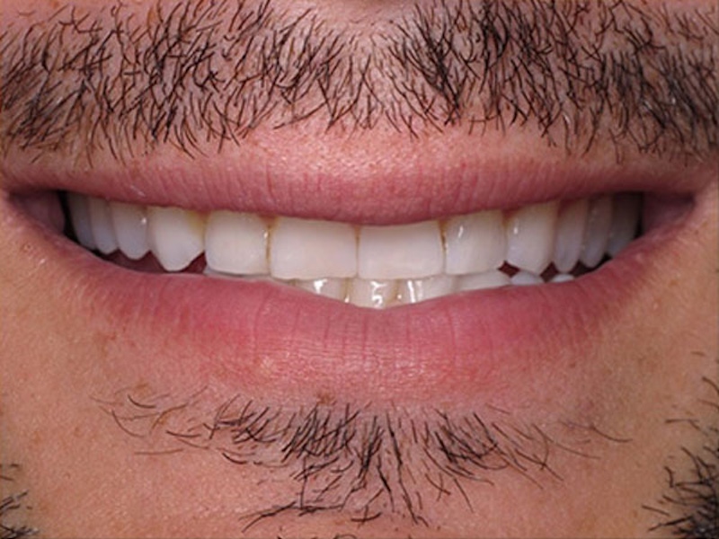 Smile Makeover Closeups Before & After Gallery - Patient 186105656 - Image 1