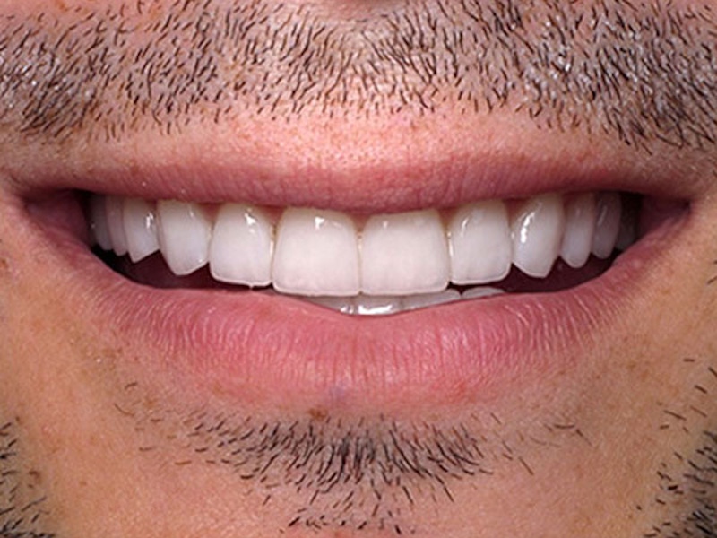 Smile Makeover Closeups Before & After Gallery - Patient 186105656 - Image 2