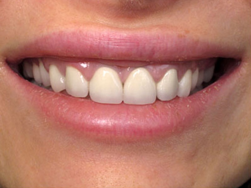 Smile Makeover Closeups Before & After Gallery - Patient 186105657 - Image 1