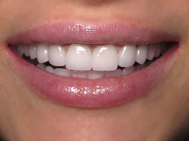 Smile Makeover Closeups Before & After Gallery - Patient 186105657 - Image 2
