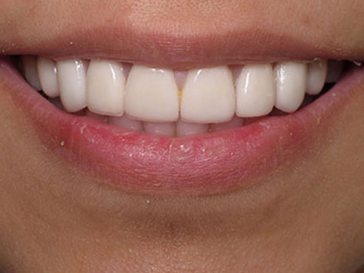 Smile Makeover Closeups Before & After Gallery - Patient 186105658 - Image 1