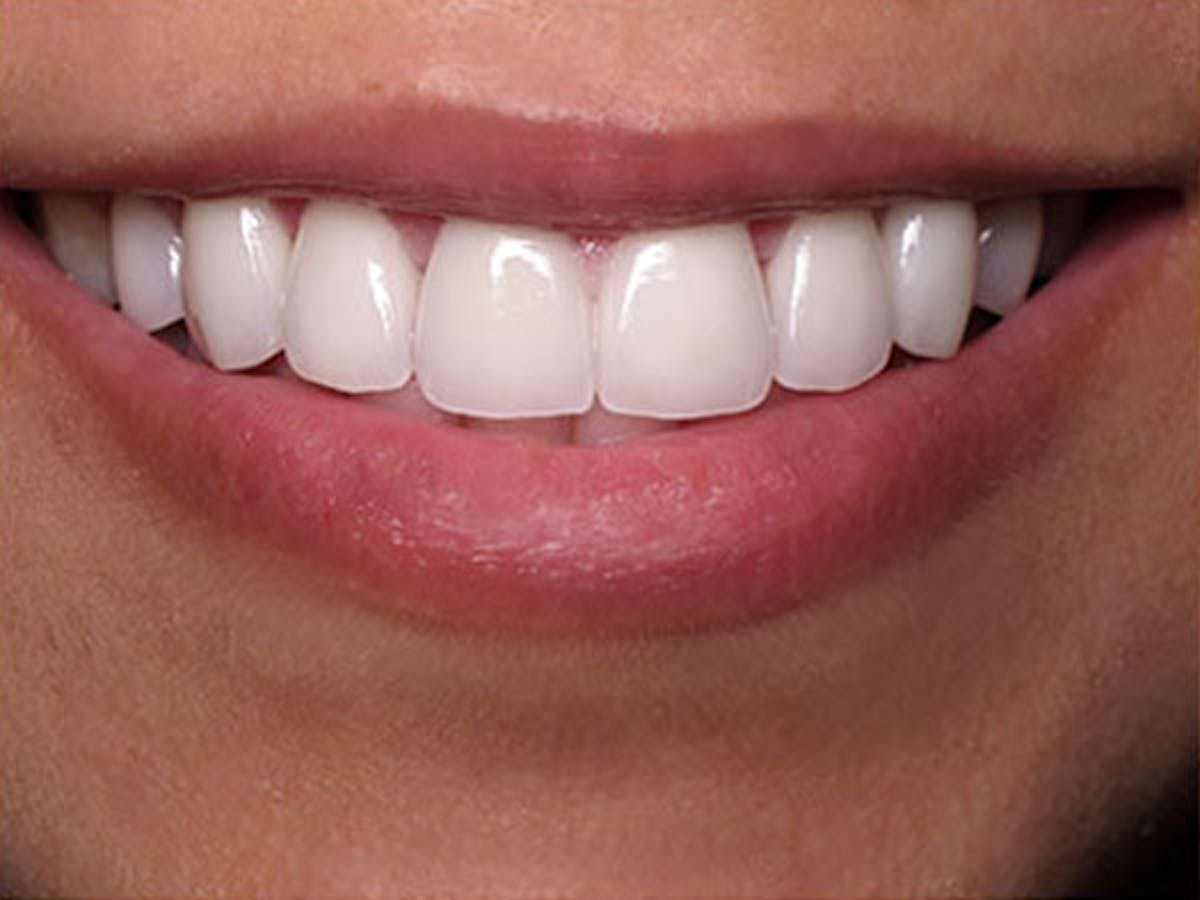 Smile Makeover Closeups Before & After Gallery - Patient 186105658 - Image 2