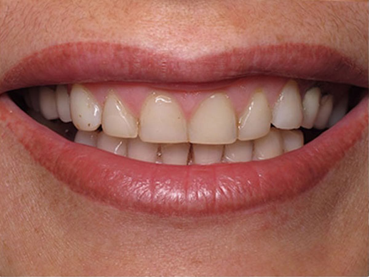 Smile Makeover Closeups Before & After Gallery - Patient 186105659 - Image 1