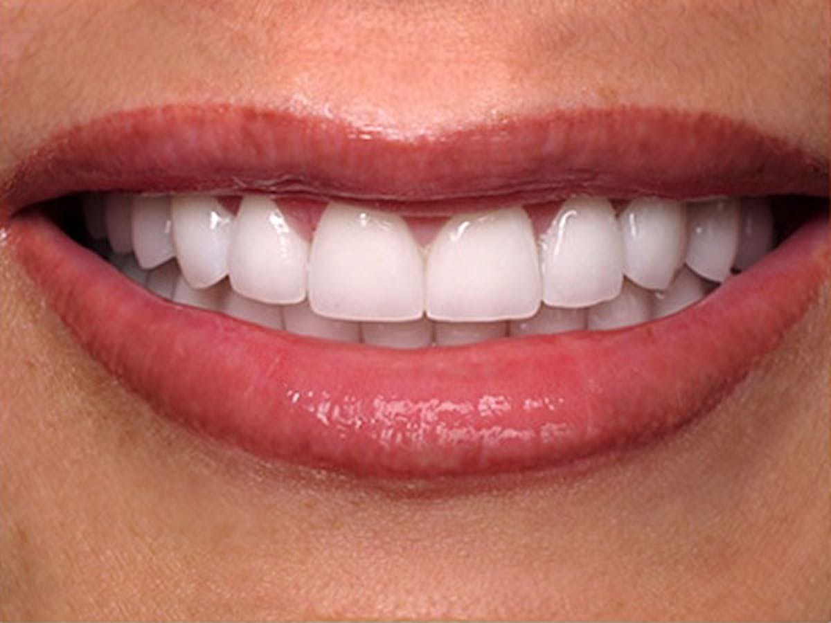 Smile Makeover Closeups Before & After Gallery - Patient 186105659 - Image 2