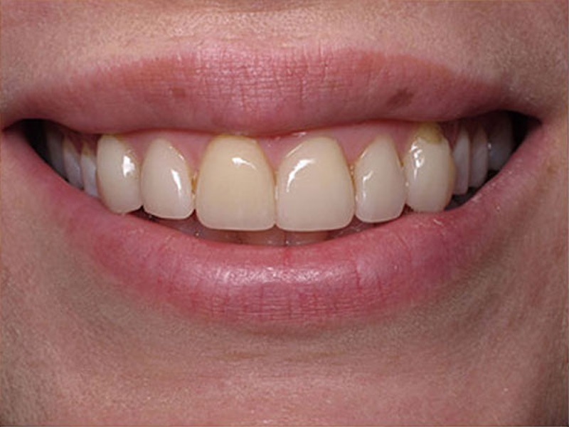 Smile Makeover Closeups Before & After Gallery - Patient 186105660 - Image 1