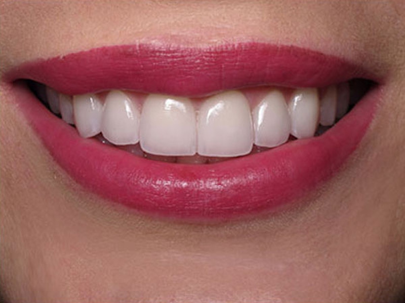 Smile Makeover Closeups Before & After Gallery - Patient 186105660 - Image 2