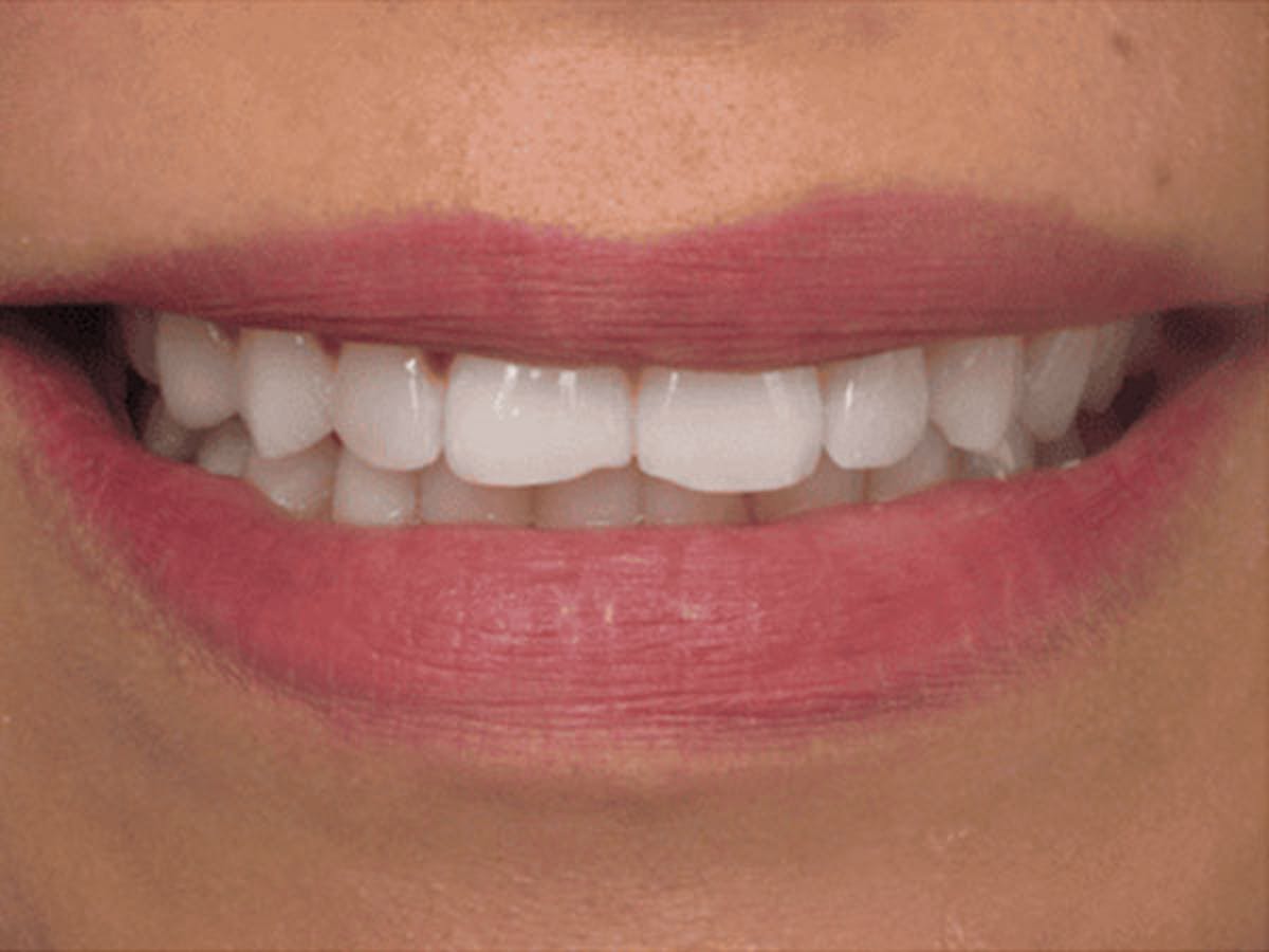 Smile Makeover Closeups Before & After Gallery - Patient 186105661 - Image 1