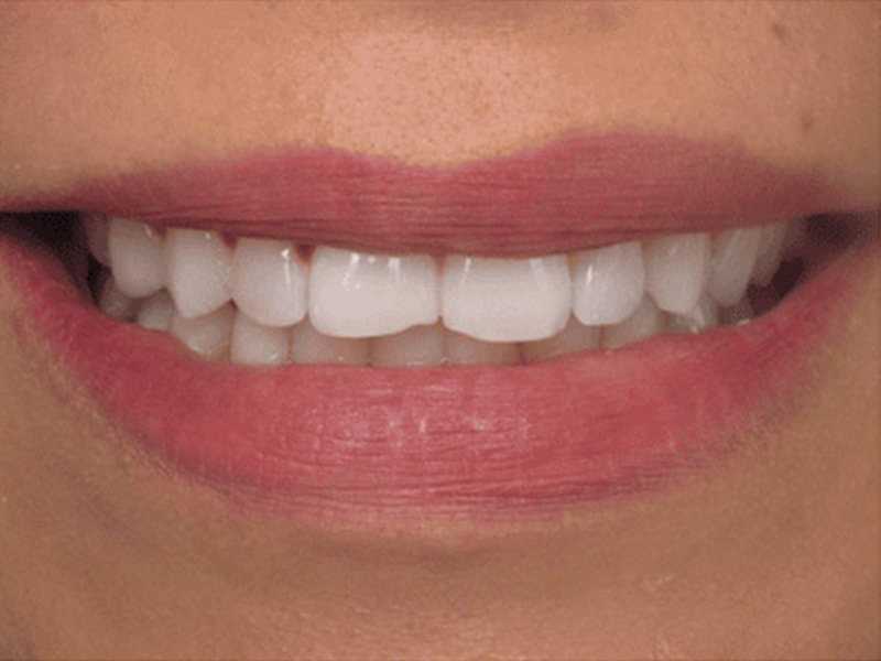 Smile Makeover Closeups Before & After Gallery - Patient 186105661 - Image 1
