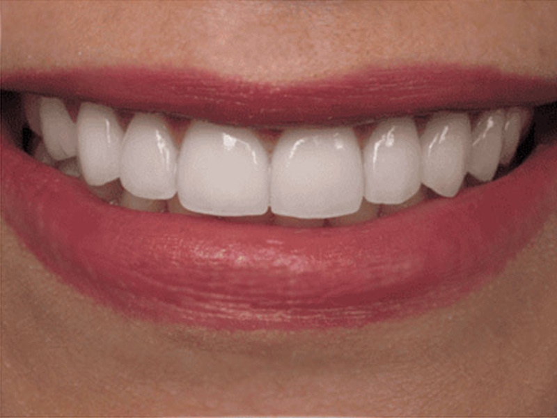 Smile Makeover Closeups Before & After Gallery - Patient 186105661 - Image 2