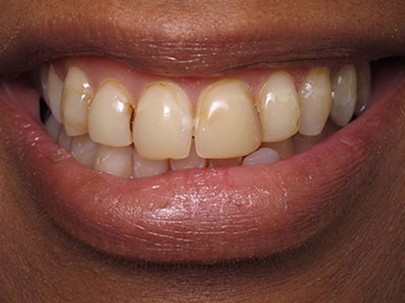 Smile Makeover Closeups Before & After Gallery - Patient 186105662 - Image 1