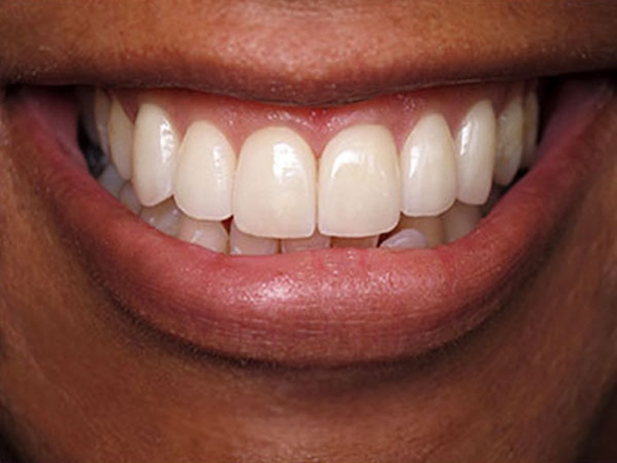 Smile Makeover Closeups Before & After Gallery - Patient 186105662 - Image 2
