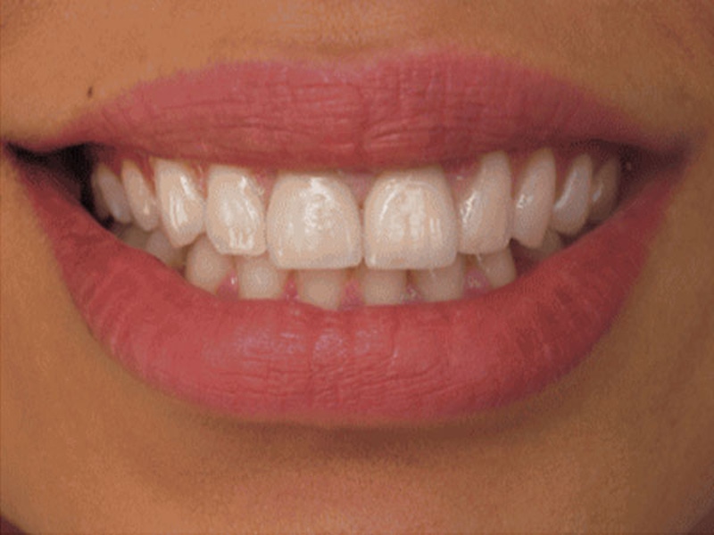 Smile Makeover Closeups Before & After Gallery - Patient 186105663 - Image 1