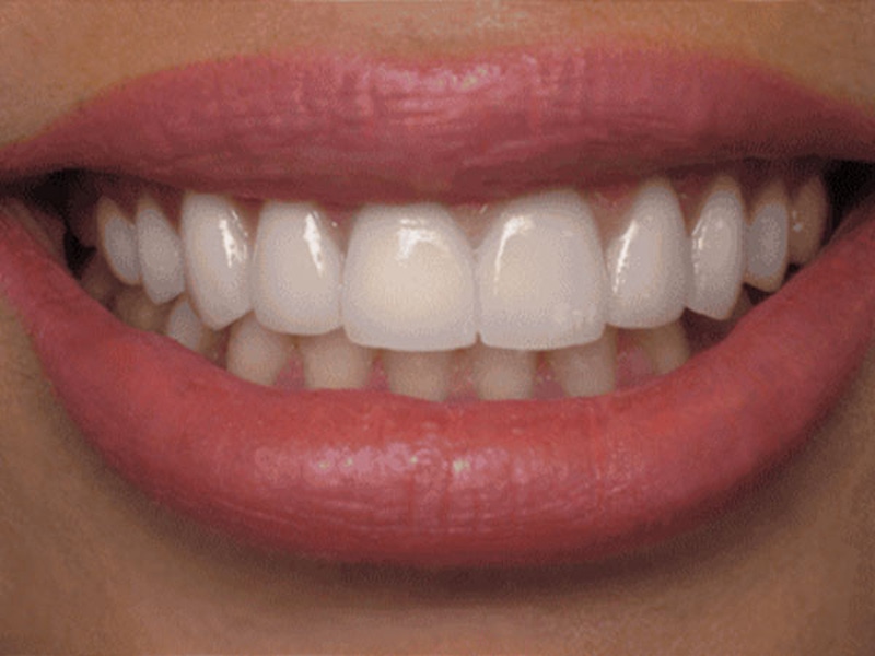 Smile Makeover Closeups Before & After Gallery - Patient 186105663 - Image 2